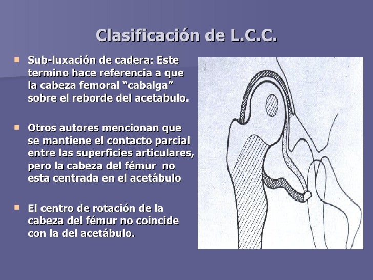 Luxacion Congenita De Cadera Pdf